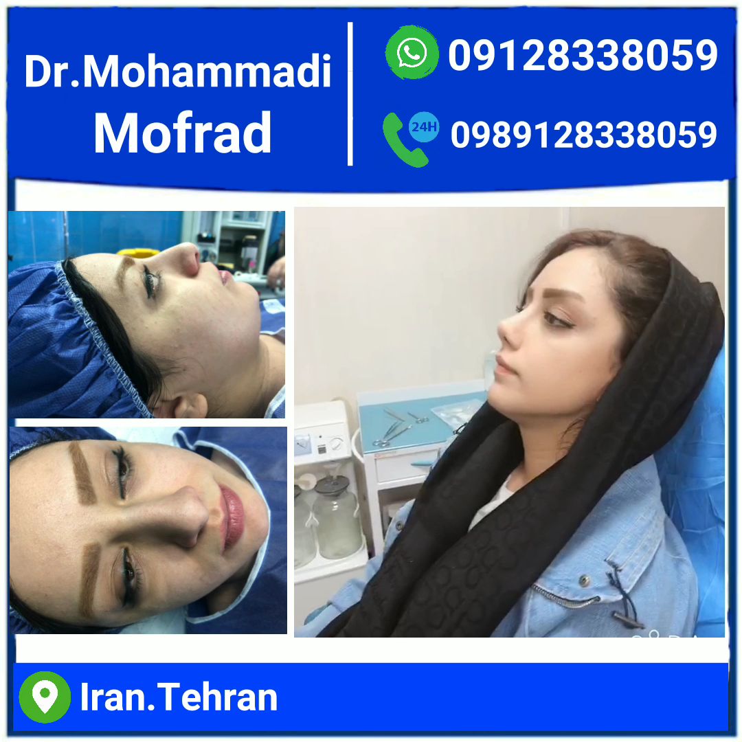 nose job by dr.mohammadimoftofrad