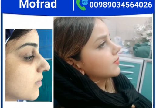 Lip lift surgery with Dr.Mohammadimofrad