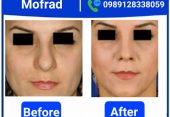 every thing about thin skin rhinoplasty